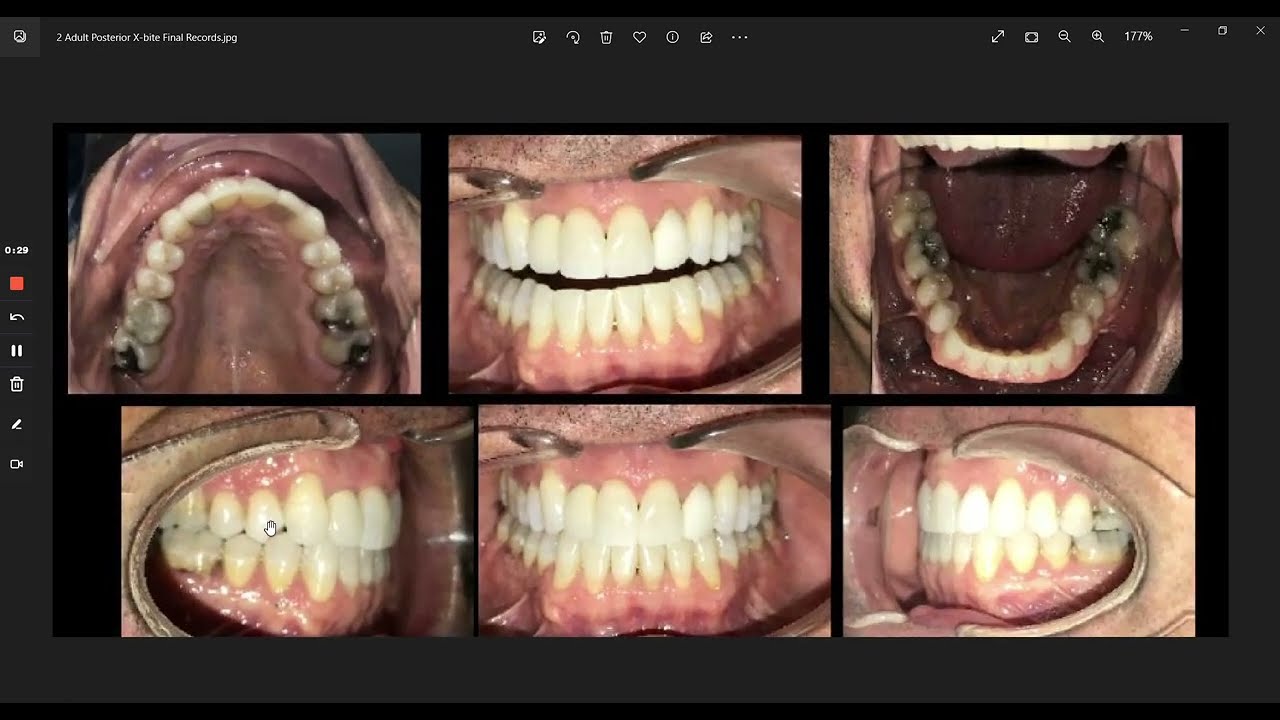 Adult Unilateral Posterior Crossbite - Clearly Aligners