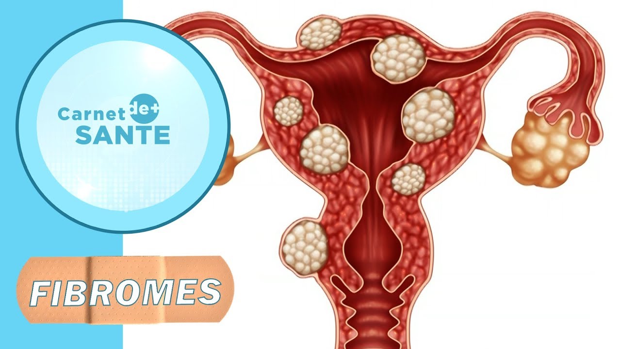Carnet de Santé | Que sont les fibromes?