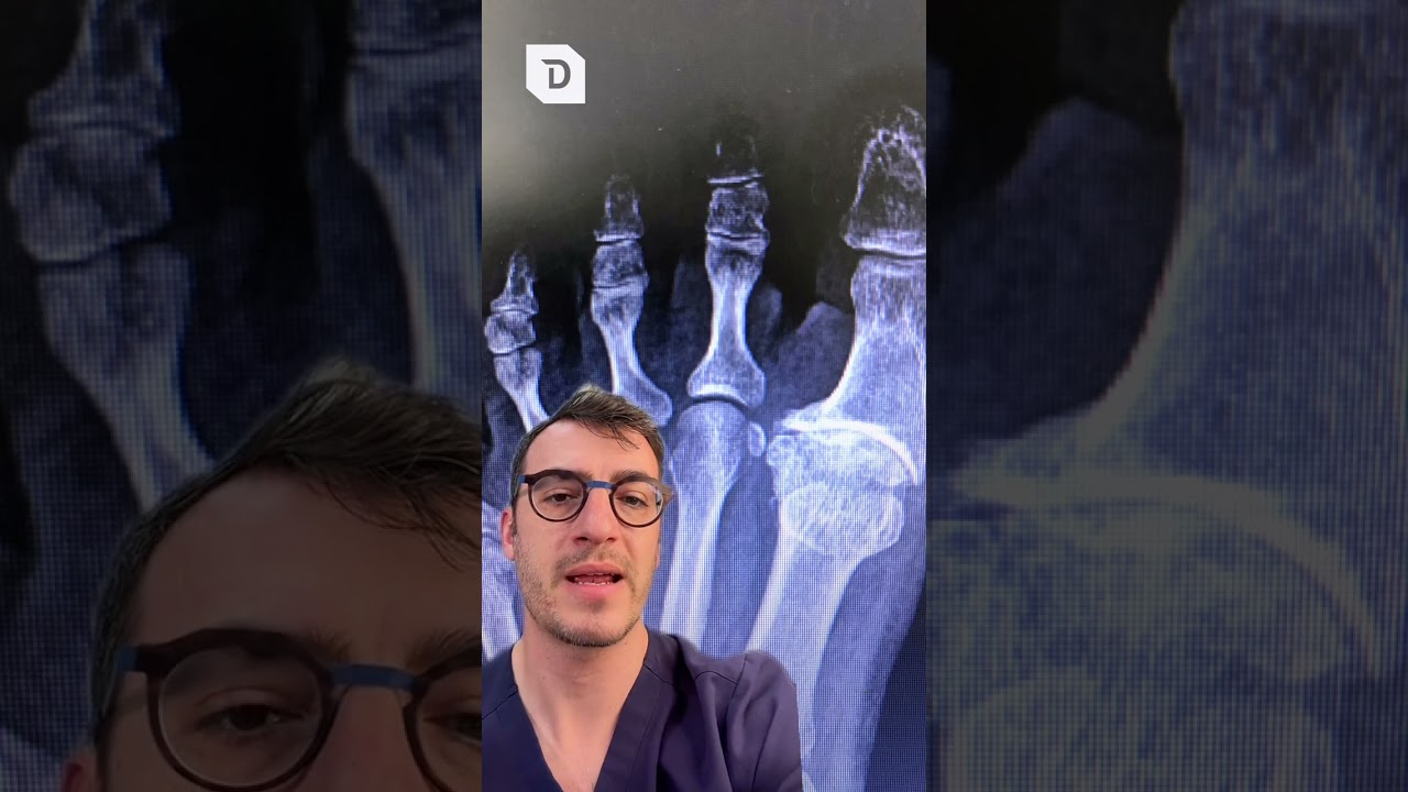 big toe fusion surgery