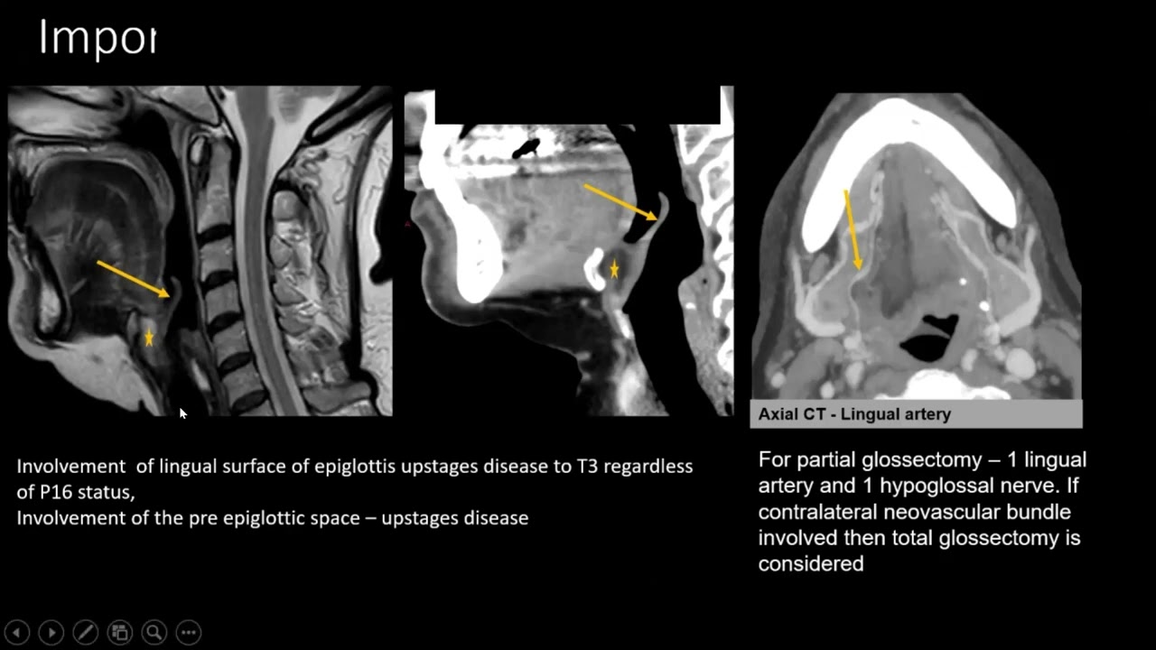 #SHNC2022: Invited Lecture: Radiology in Oropharyngeal Cancer - Anu Kamalsan