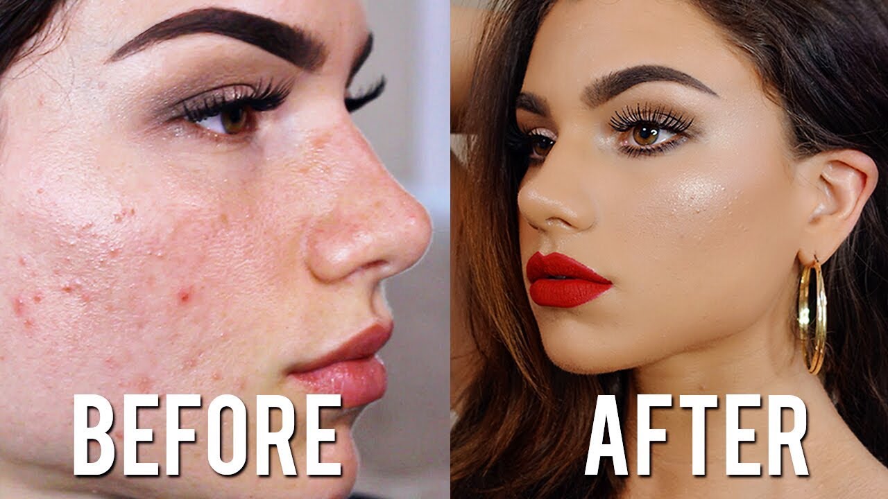 How To Cover ACNE & SCARS with Makeup! Full Coverage Foundation & Concealer Tutorial