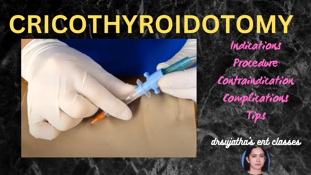 205.cricothyroidotomy  #cricothyrotomy procedure #airway #emergency #stridor