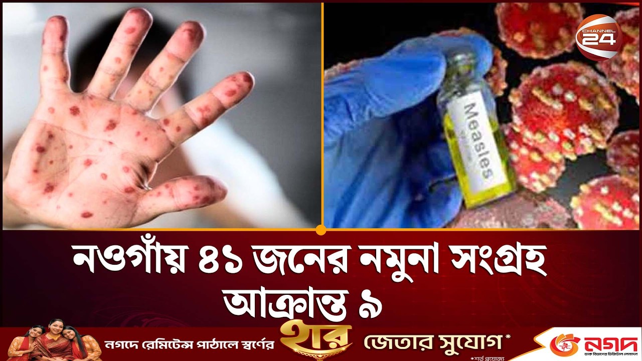 নওগাঁয় ৪১ জনের নমুনা সংগ্রহ, আক্রান্ত ৯ | Naogaon Measles News | Channel 24