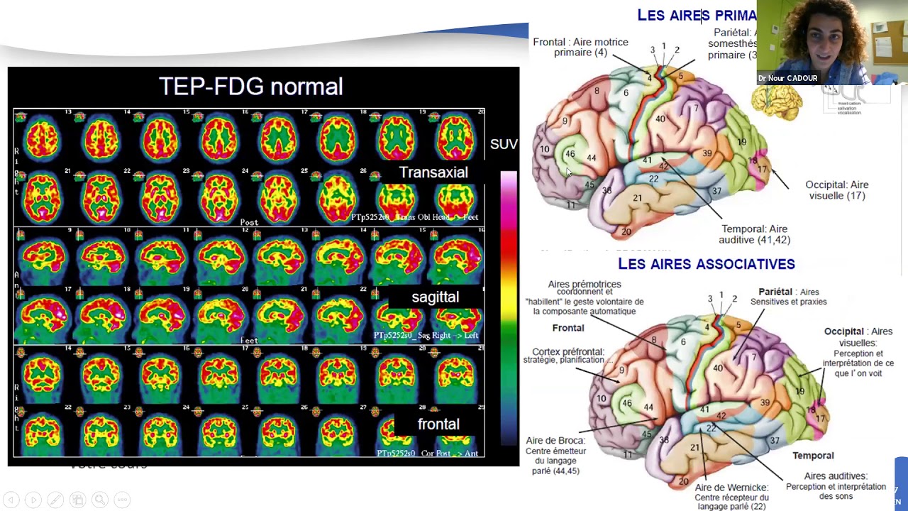 Applications de la TEP-TDM en neurologie - Conf&eacute;rence ANAIMEN - Dr CADOUR