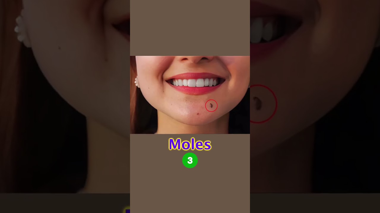 How to manage moles & open pore: Skin Care Tips | Dr. Sarin |