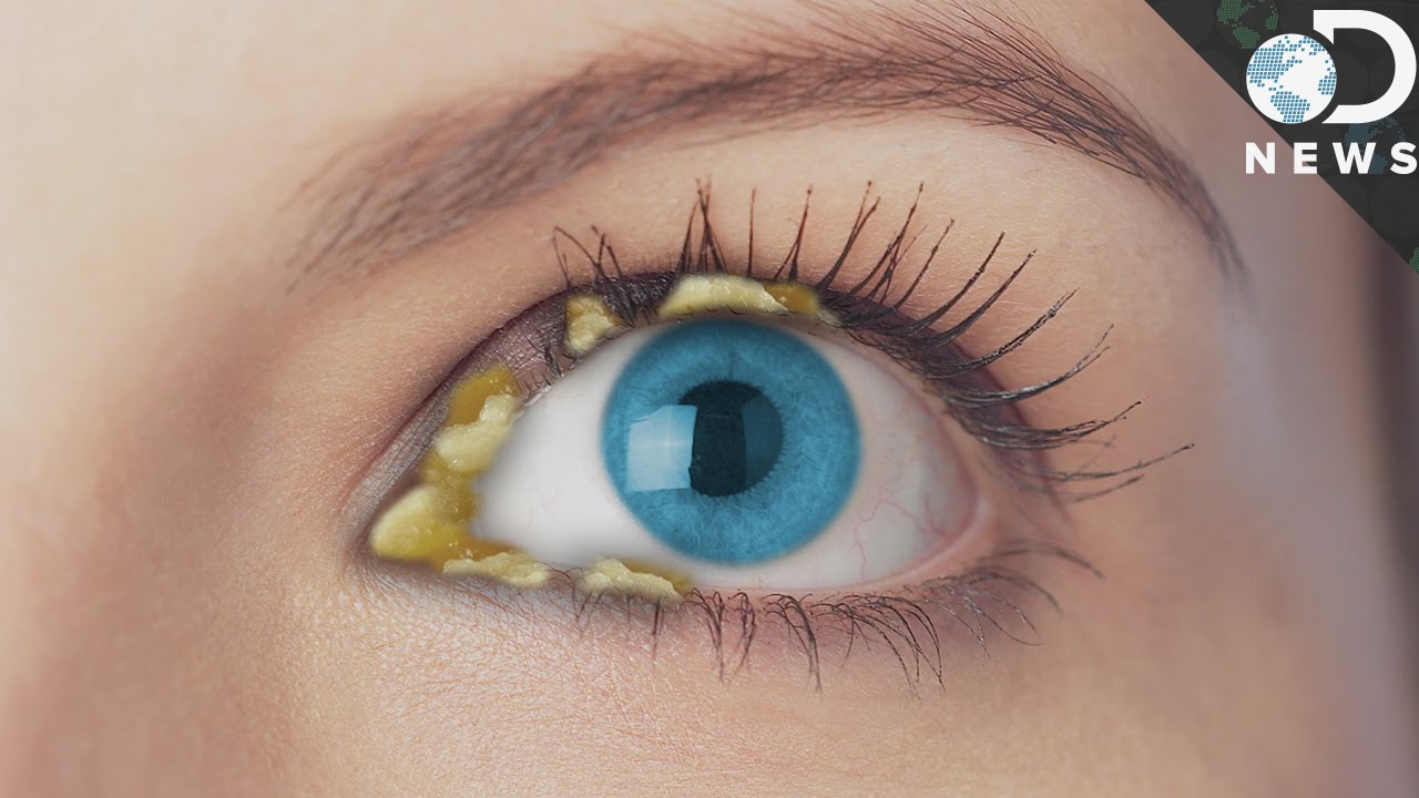 Why Do We Get Eye Boogers?