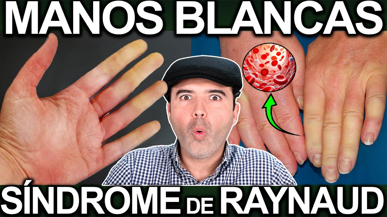 COMO ELIMINAR EL SINDROME DE RAYNAUD O MANOS BLANCAS AZULADAS - Causas y Soluciones