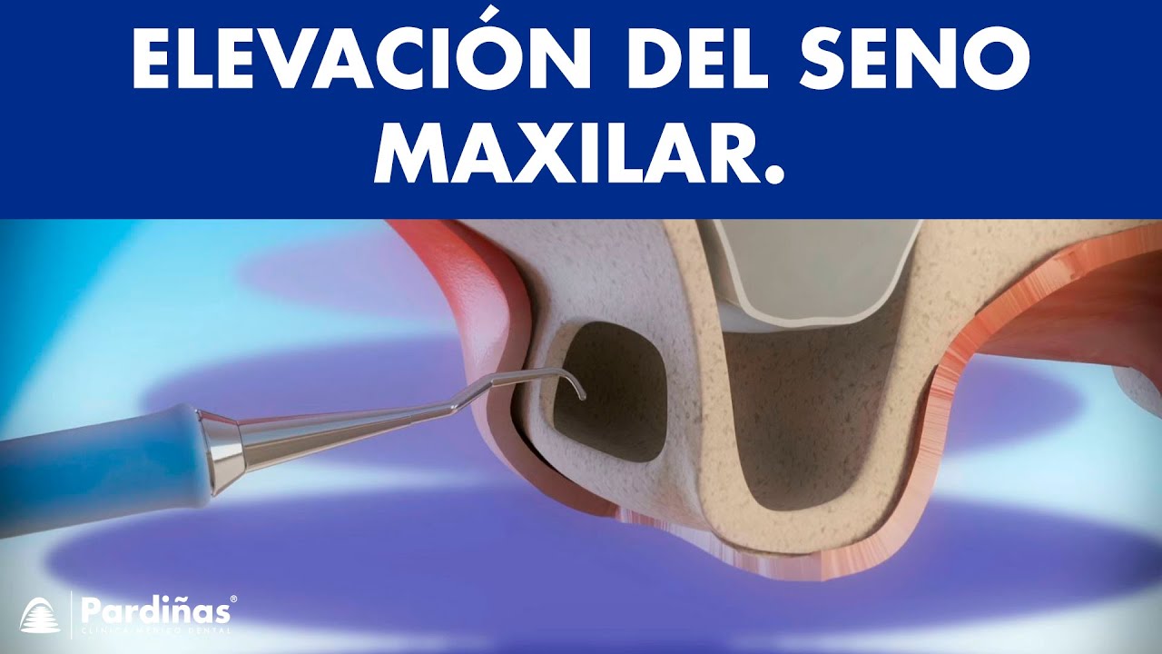 Elevaci&oacute;n de seno maxilar - Injerto de hueso &copy;