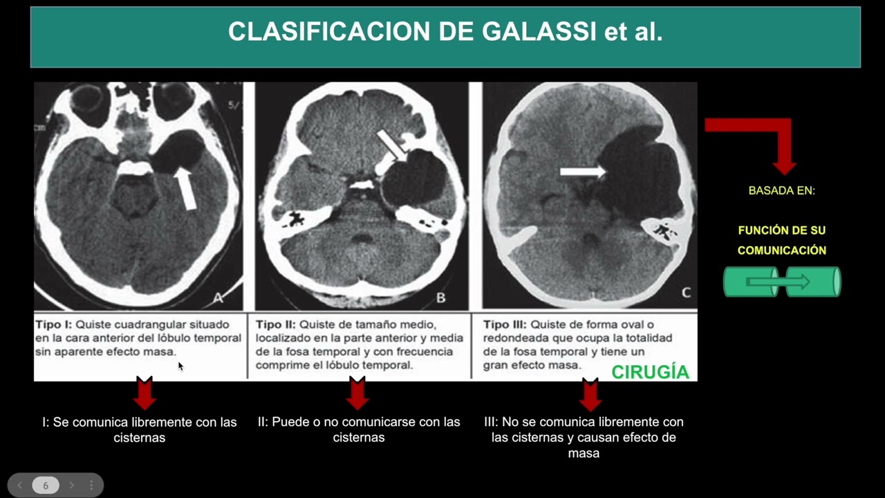 QUISTE ARACNOIDEO