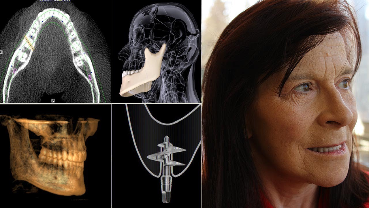Implant dentaire basal #1 : Sans greffe osseuse avec 1 mm d'os