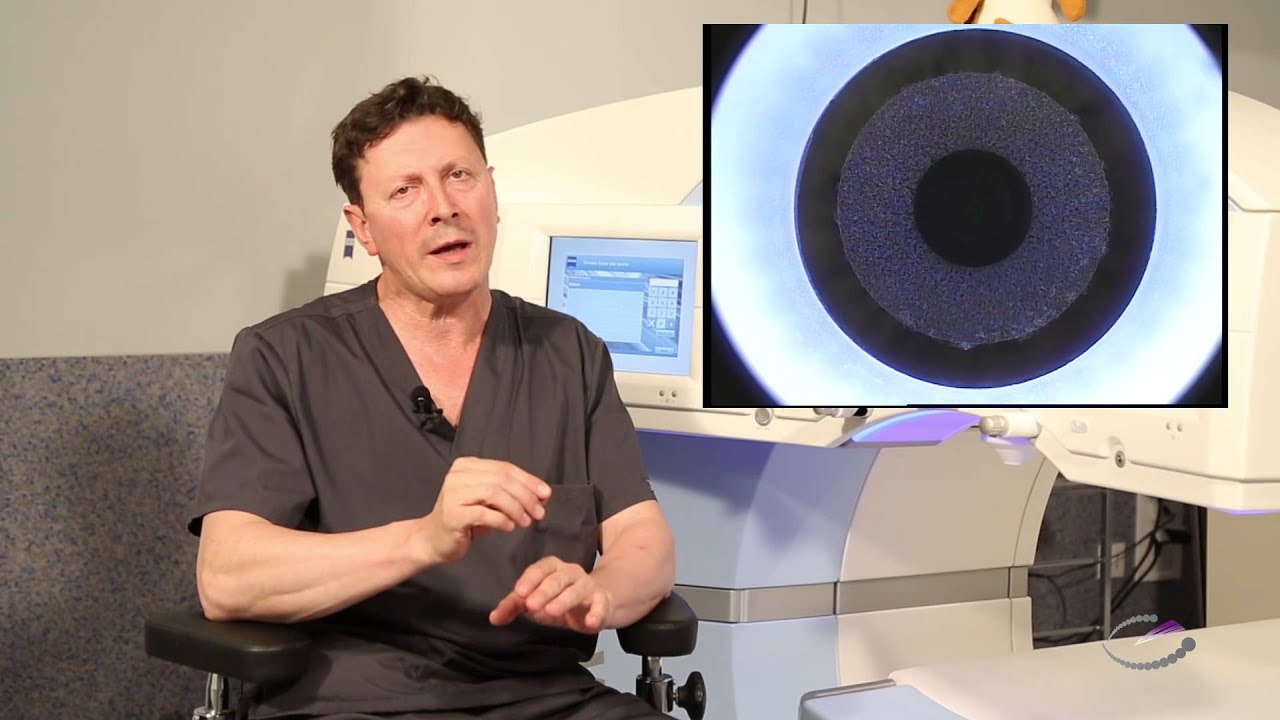 Cirugía de Miopía con Relex Smile. Explicación completa. Tecnoláser Clinic Vision