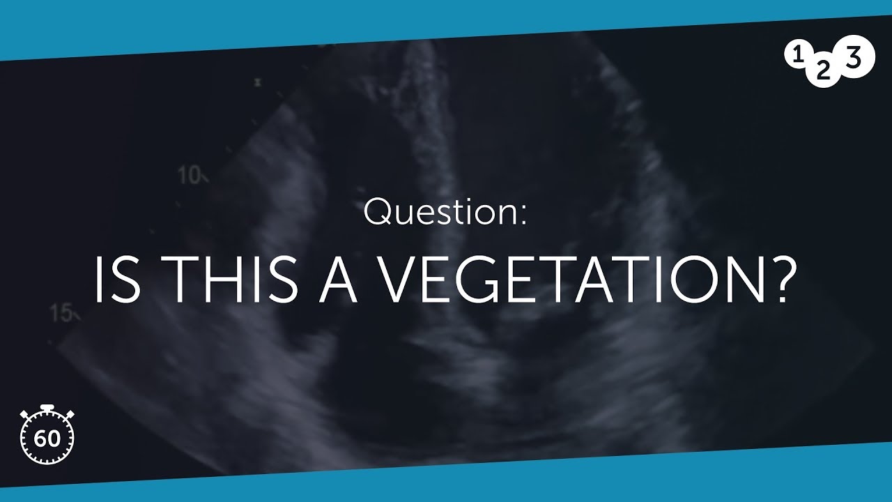 60 Seconds of Echo Teaching Question: Is this a vegetation?