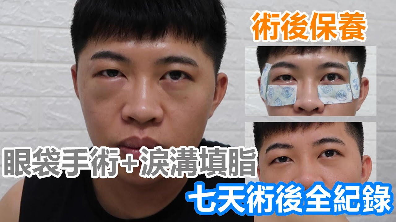 【元智】第一次做無痕眼袋手術+淚溝填脂七日術後保養全紀錄