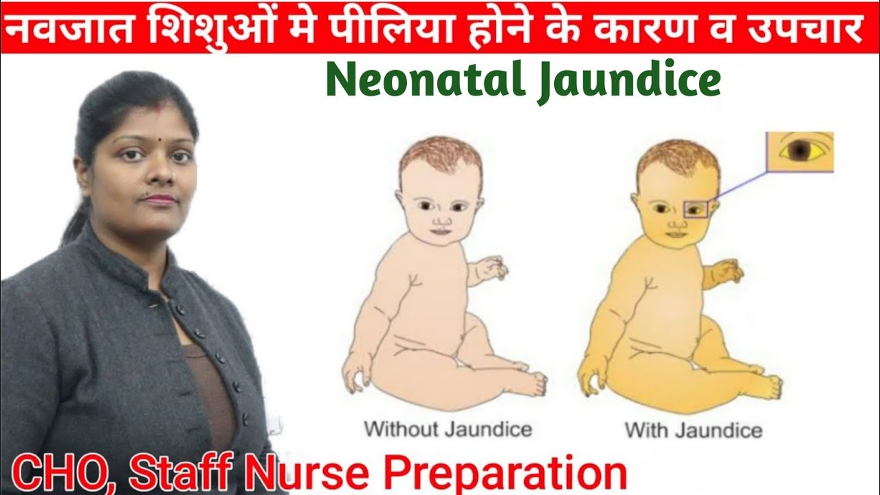 Physiological Neonatal jaundice with causes, types & treatment in hindi || level of bilirubin