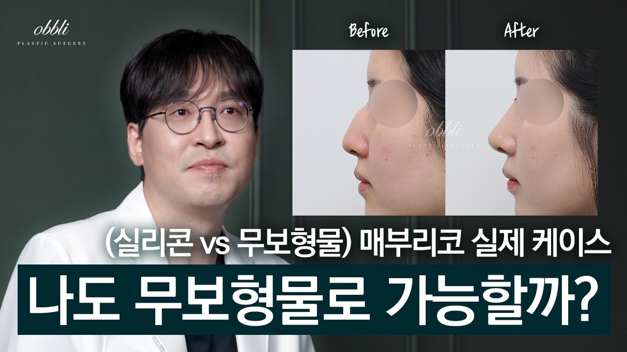 매부리코수술, 나도 무보형물로 가능할까?ㅣ실리콘, 무보형물 케이스 소개