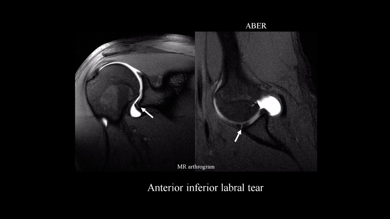 MRI shoulder labrum pathology