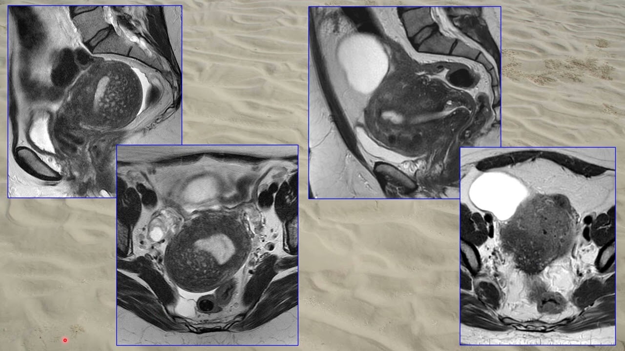 M. Bekiesińska-Figatowska - Endometrioza i adenomyosis