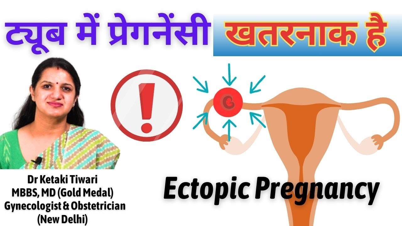 Ectopic Pregnancy | ट्यूब में प्रेग्नेंंसी । बच्चा गर्भाशय के बाहर विकसित होना । बेहद खतरनाक