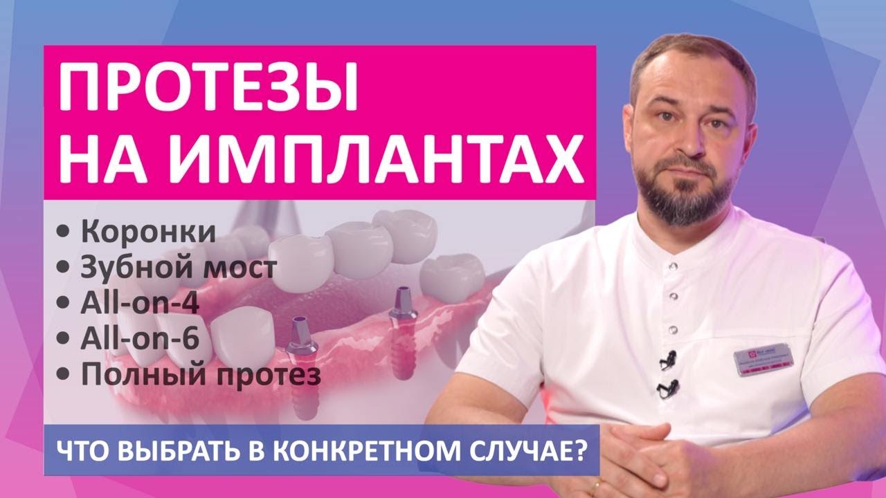 Протезы на имплантах - зубные коронки, зубной мост, полный протез, all-on-4, all-on-6