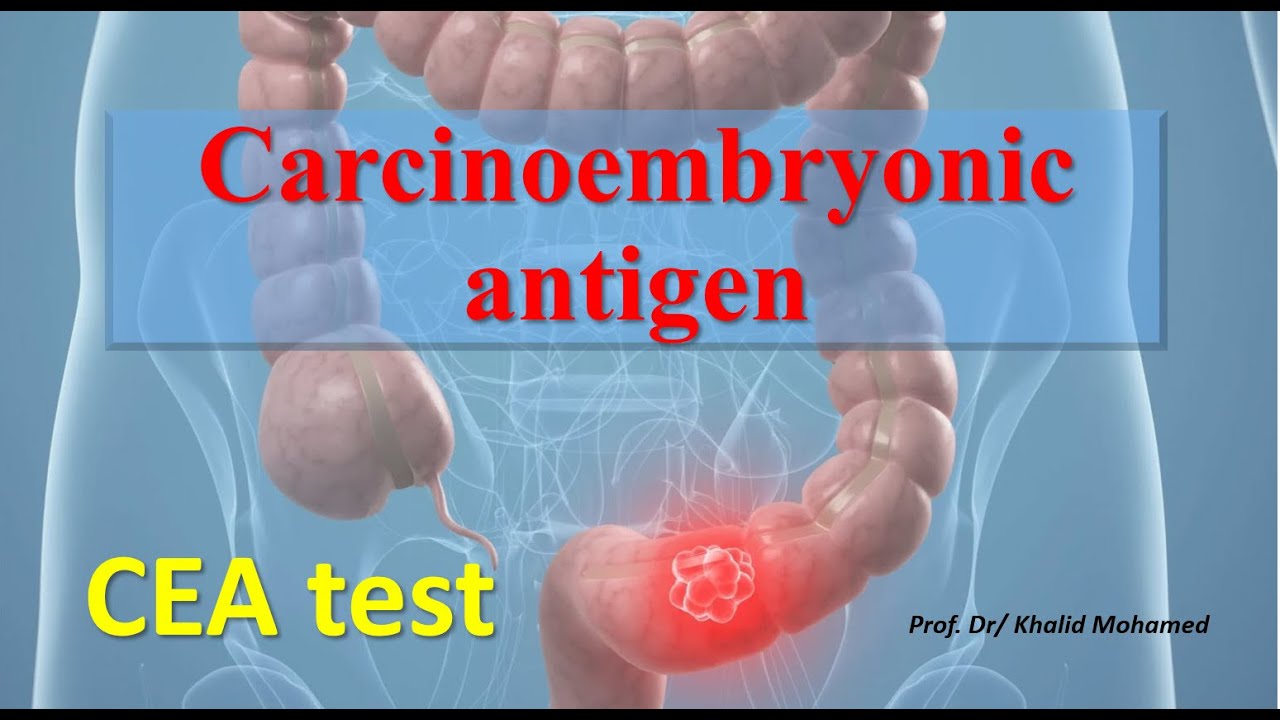 Carcinoembryonic antigen (CEA) test
