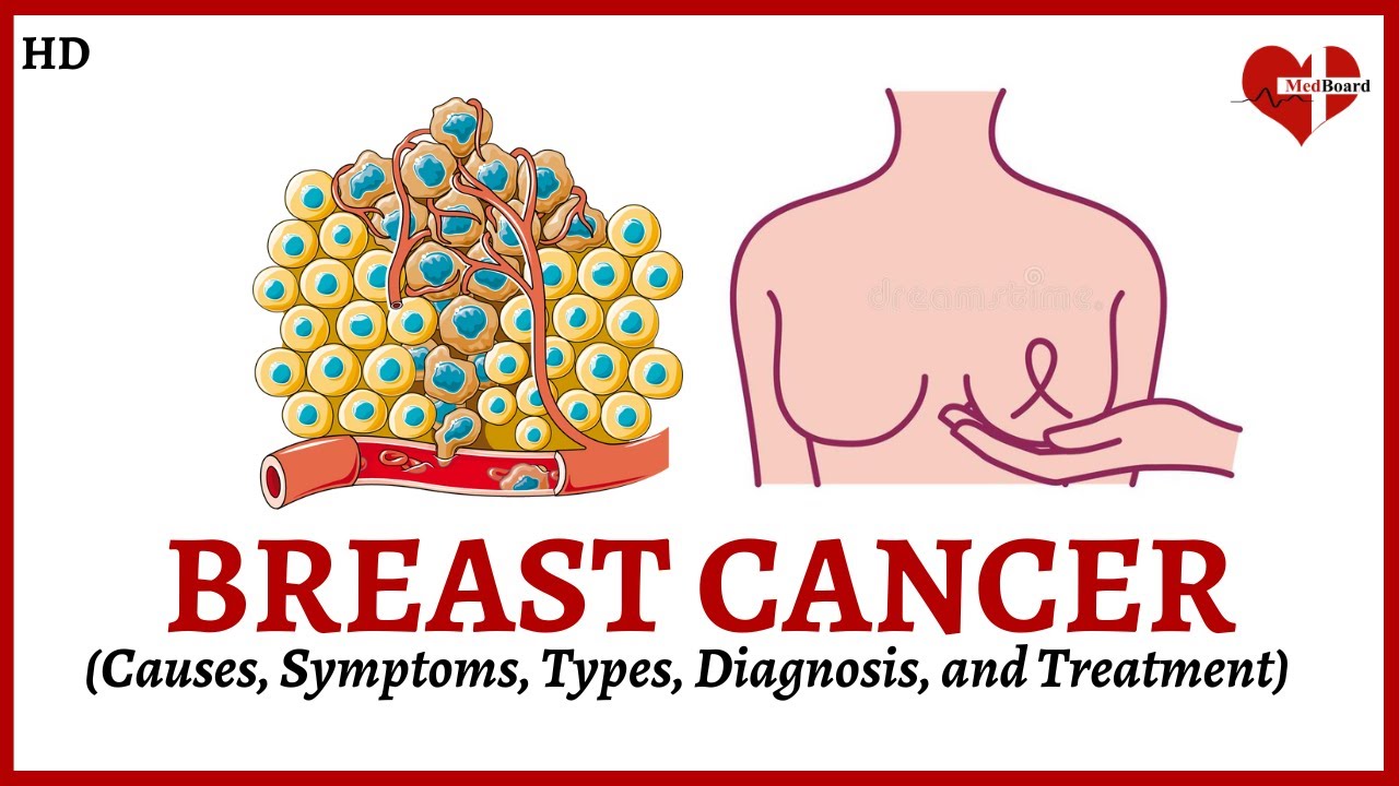 Overview of Breast Cancer:  Causes, Symptoms, Types, and Treatment Explained