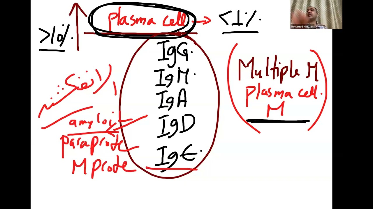 11 - MULTIPLE MYELOMA - MGUS