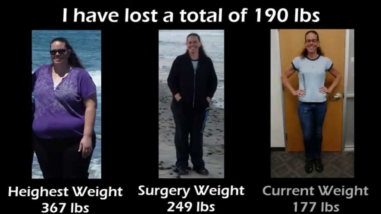 1 Year After Gastric Bypass Surgery - A Patient's Journey