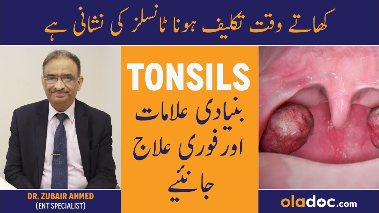 Tonsils Ka Ilaj In Urdu - Tonsils Symptoms Treatment - Galay Ke Gadood Barhna - Tonsils Ki Alamat