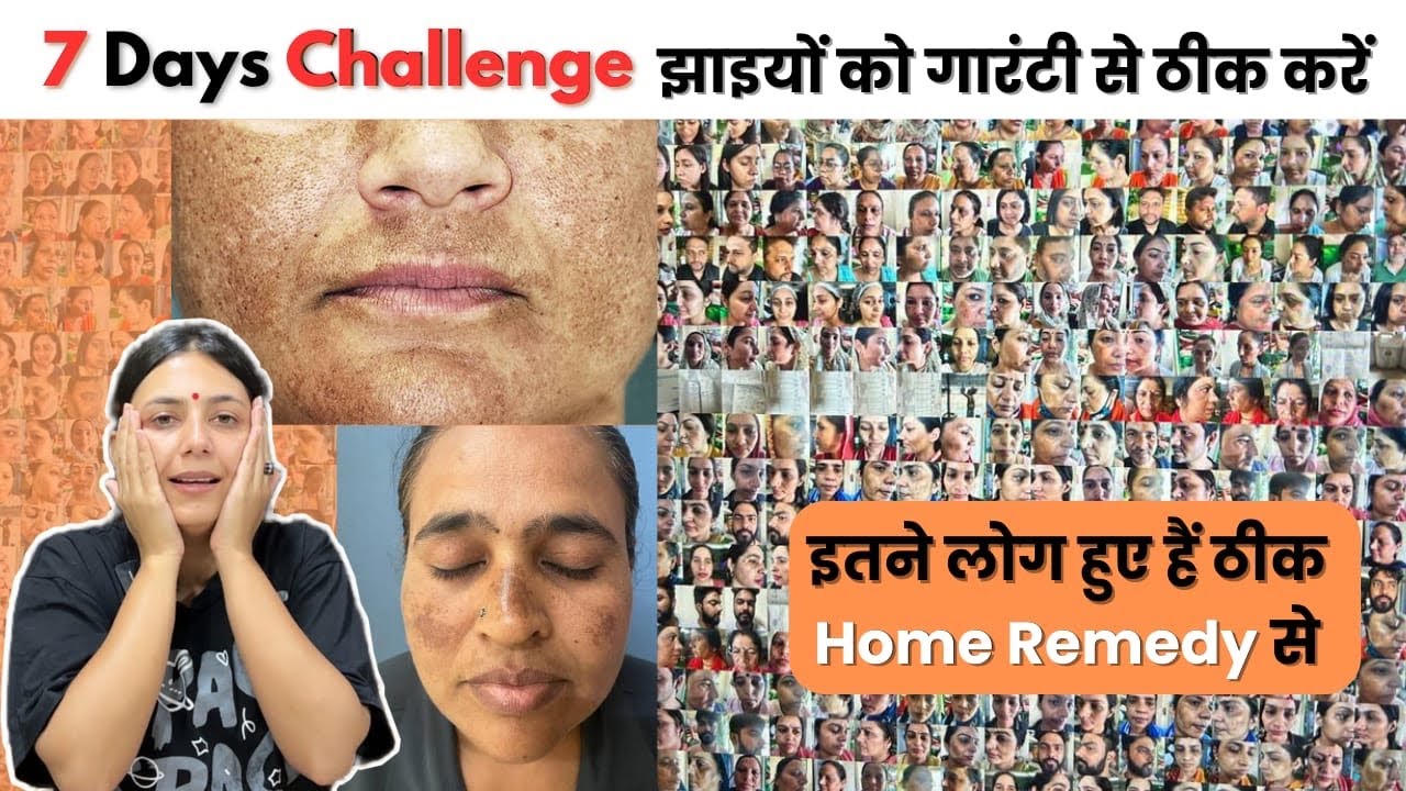 7 दिन में झाइयों में फर्क देखें - पुरानी से पुरानी Pigmentation को ठीक करें | Dr. Upasana Vohra