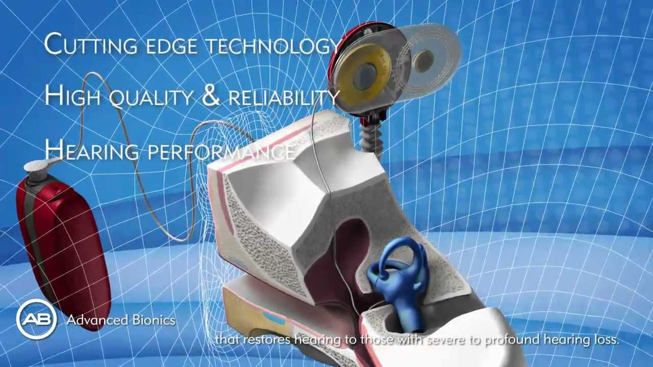Advanced Bionics HiResolution Bionic Ear system: HiRes90K cochlear implant Neptune Harmony SoundWave