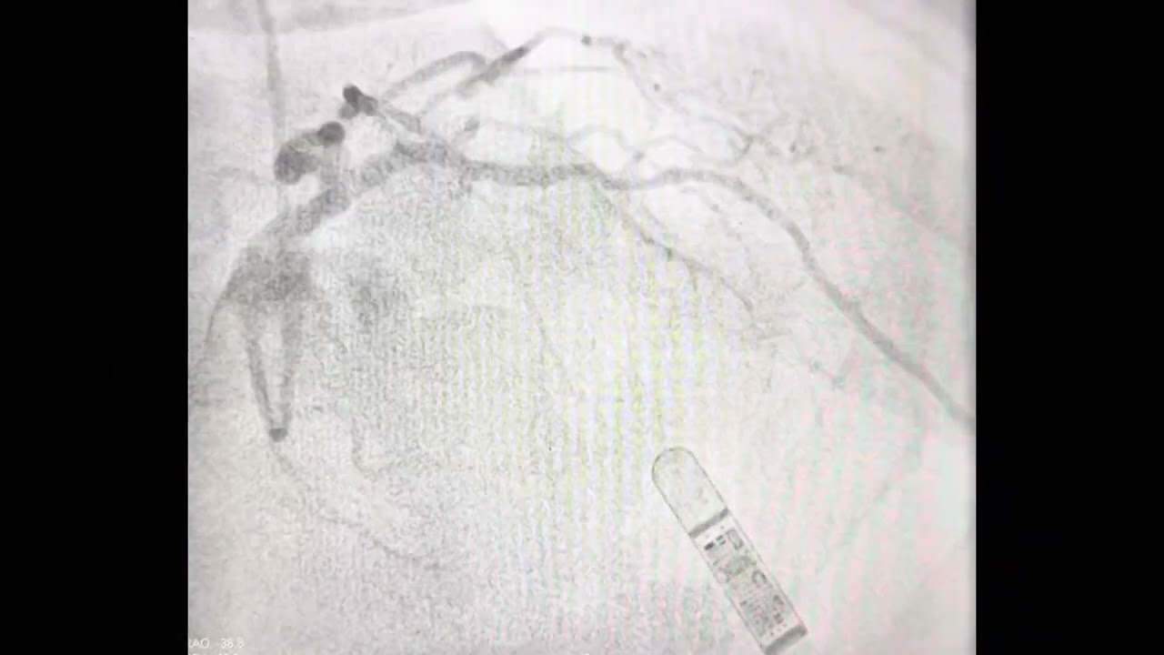Complex ostial LAD stenosis- How to tackle?