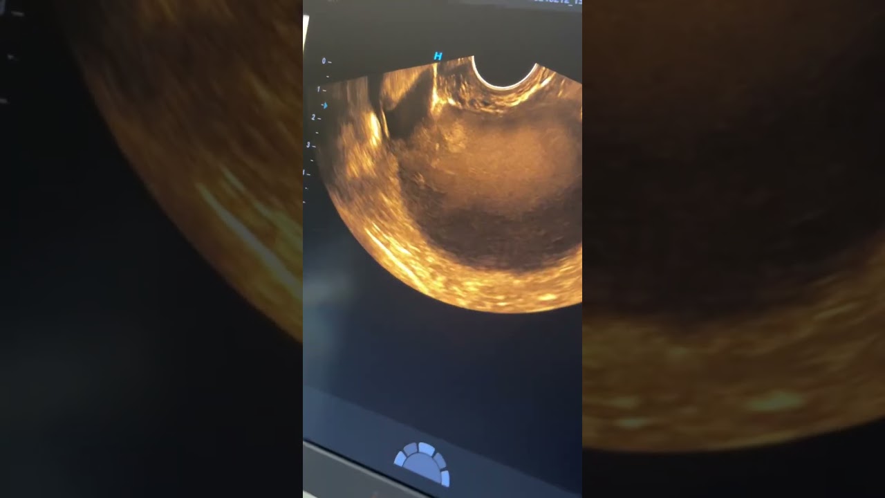Çikolata kisti/Endometriozisin ultrason görüntüsü