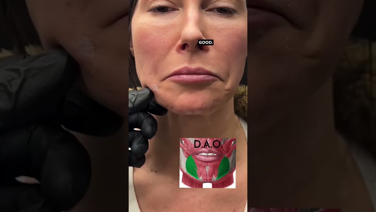 Lower Face Botox😳 | Dr. Jaluvmabody