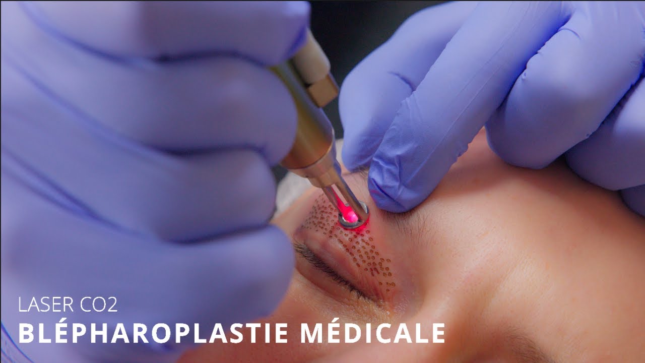 Blépharoplastie médicale avec laser CO2 Silkplex© exclusivement à la Clinique ReGeneva