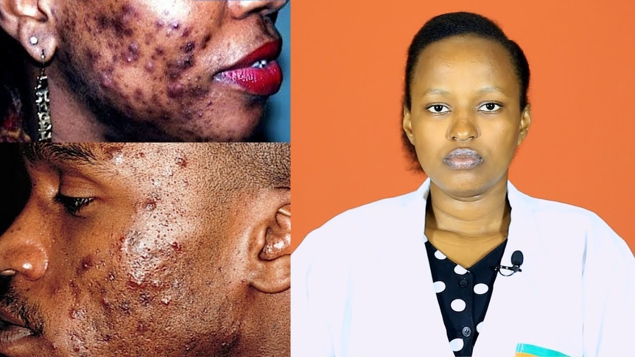 Tandukana n’IBIHERI BYO MU MASO(Acne) RYA NEZA USE NEZA!