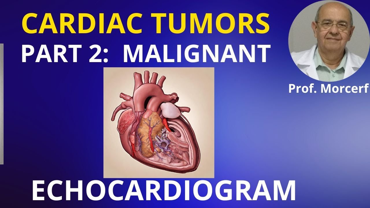Secrets of Dealing with Malignant Cardiac Tumors. #echocardiography