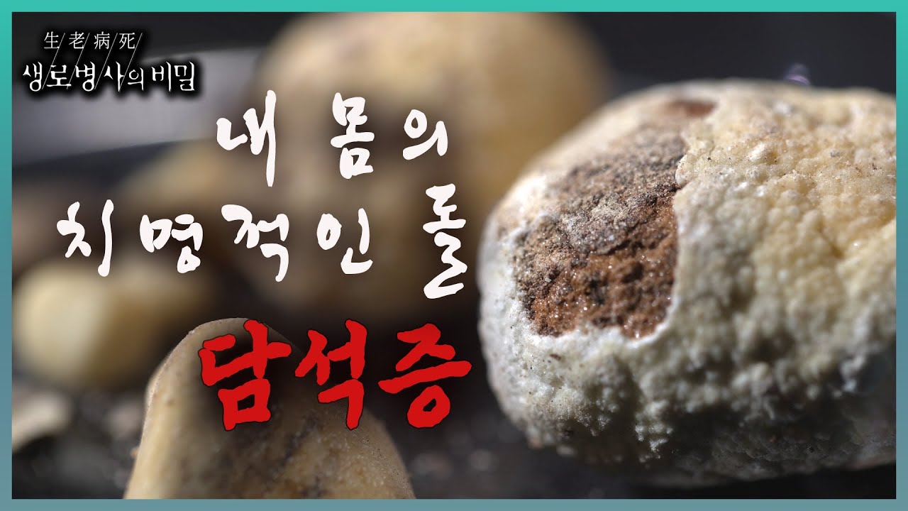 📌방송 하이라이트📌 방치하면 치명적인 합병증을 부르는 담석증의 주요 원인과 최적의 치료법을 소개한다  l KBS 20231018 방송