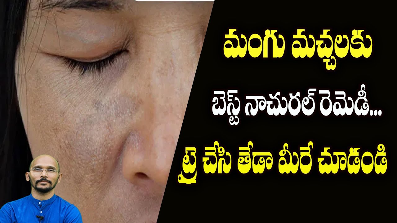 మంగుమచ్చలకు బెస్ట్ నాచురల్ రెమెడీ, ట్రై చేసి తేడా మీరే చూడండి| Pigmentation| DrMadhuBabuHealthTrends