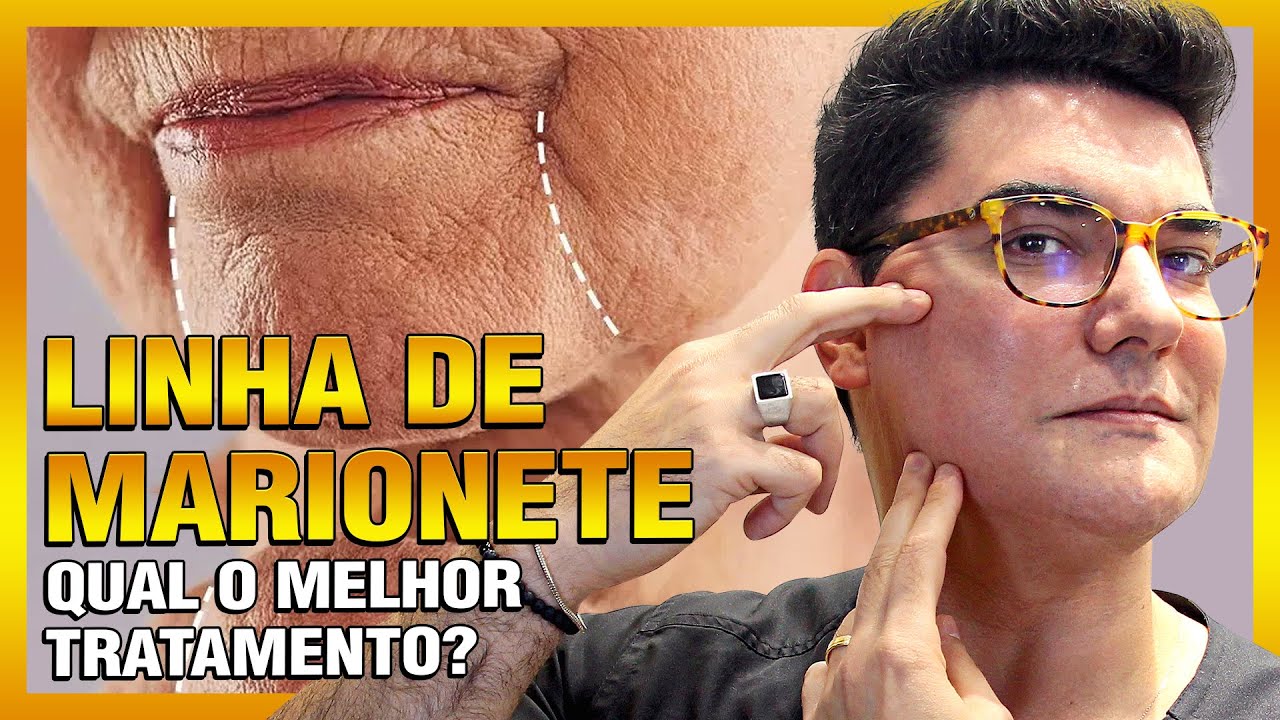 Linha de Marionete: Qual o Melhor Tratamento?