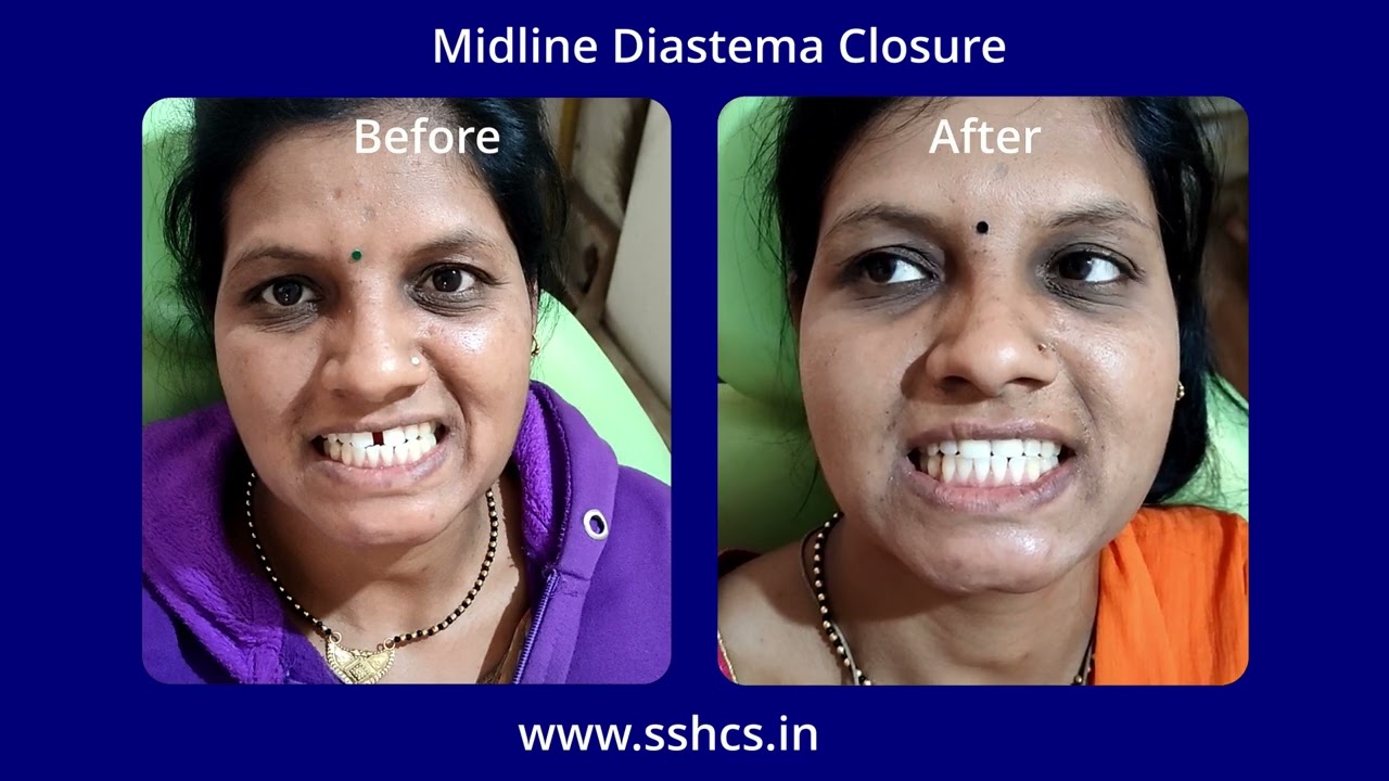 Midline Diastema Closure