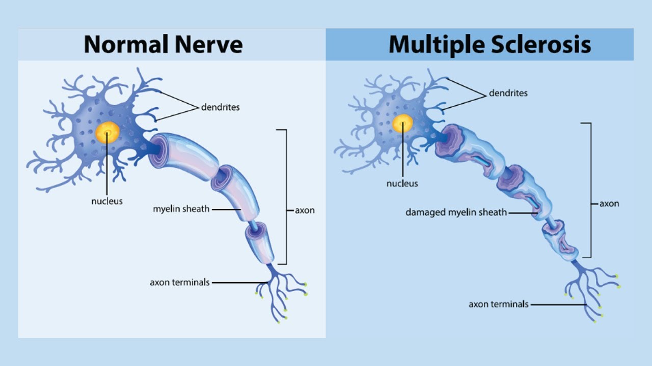 Multiple Sclerosis Explained (Whispering ASMR Tutor)