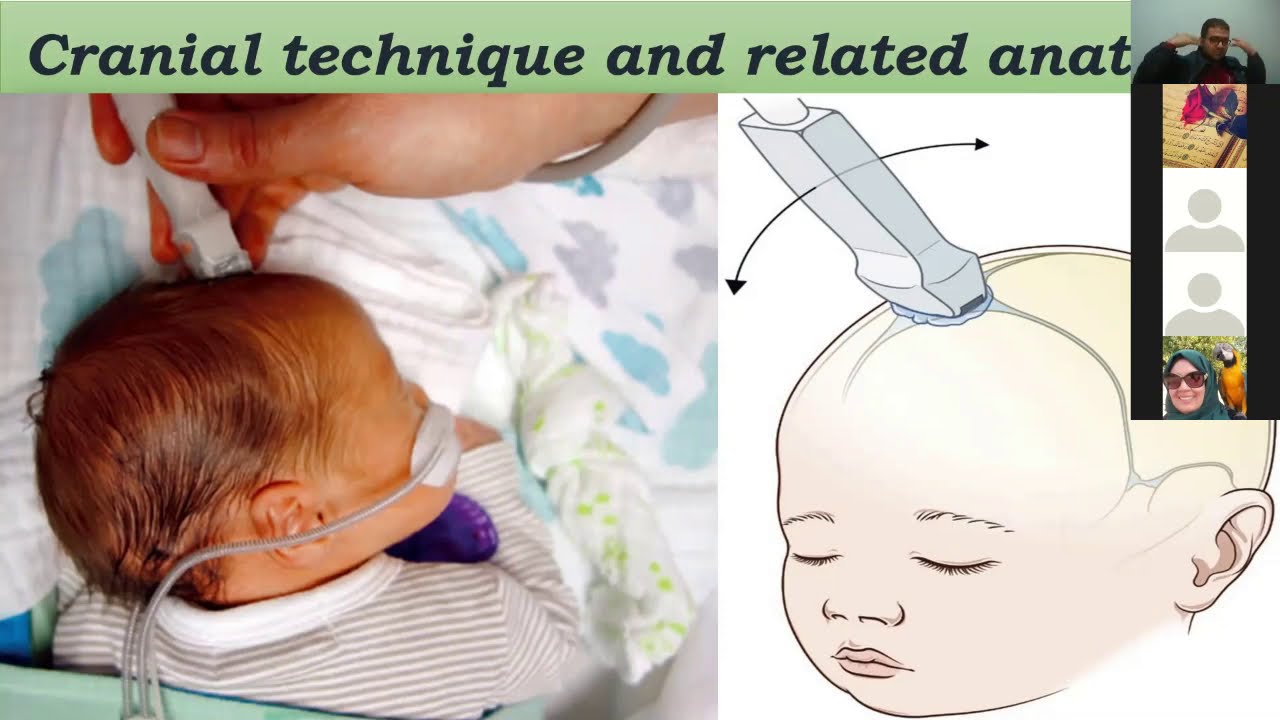 (2) Neonatal Cranial Ultrasound technique and anatomy - Dr.Mohamed soliman