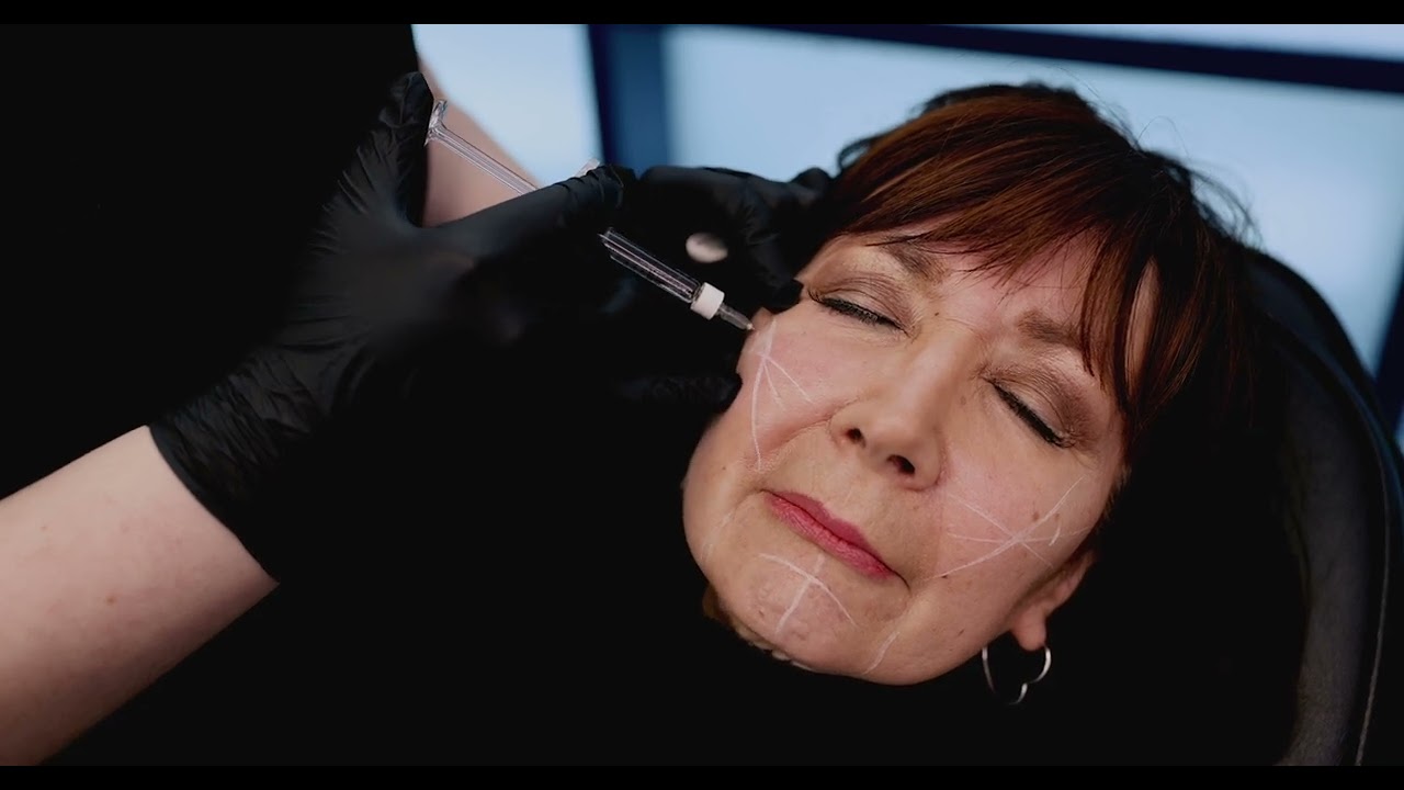 Regenevue Sub-Q Filler for Jawline and Cheek