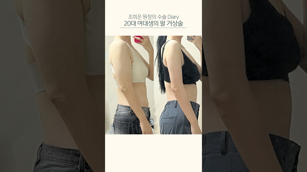 60kg 감량 후 처진 팔뚝살 제거😊#brachioplasty #liposuctuon #팔뚝성형 #팔거상 #지방흡입 #팔리프팅 #팔지방흡입 #수술실 #성형수술 #조희은원장 #쇼츠