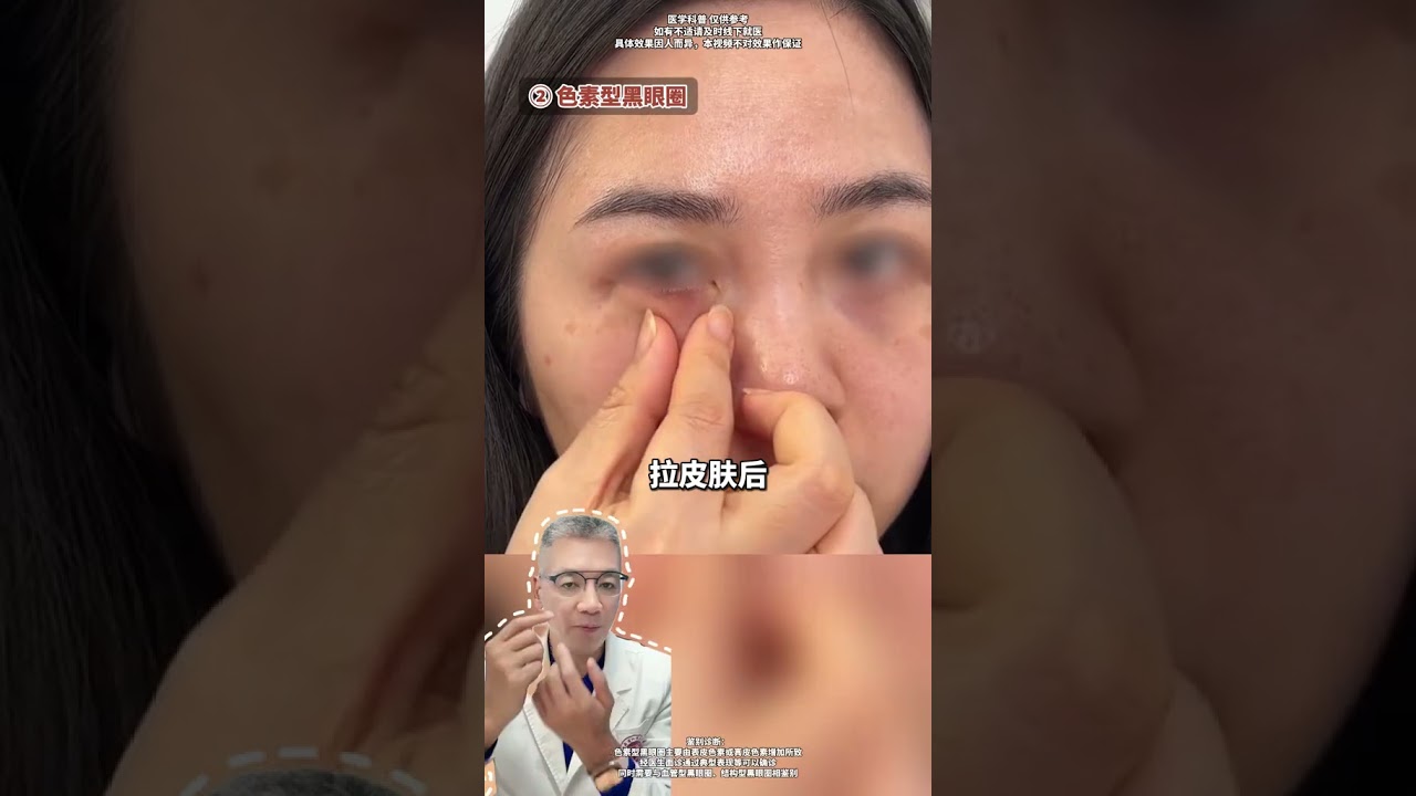 Cienie pod oczami mogą się kumulować. Sprawdź, jaki masz typ cieni pod oczami.