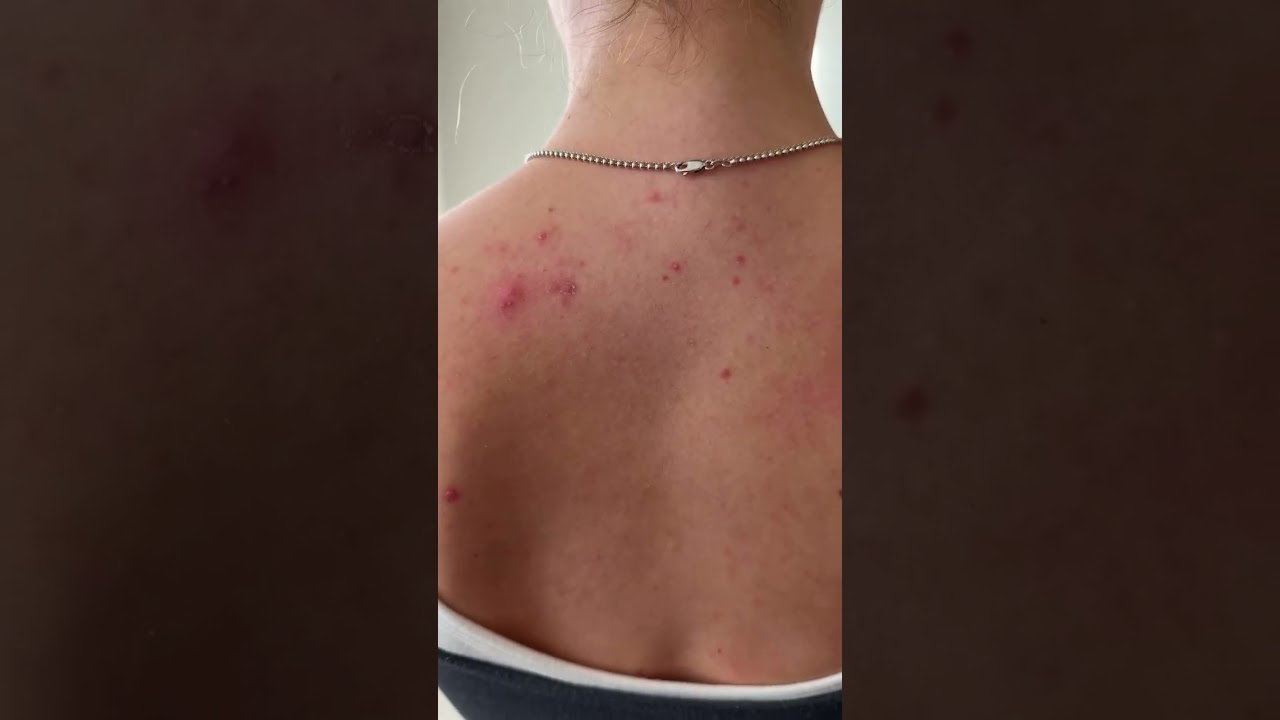 PanOxyl Acne Banishing Body Spray Post-workout Routine