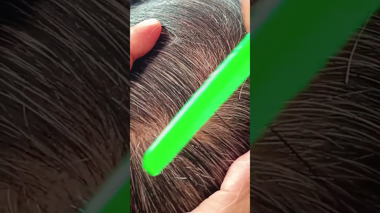 Most satisfying white hair removal#31#satisfying #musicbackground