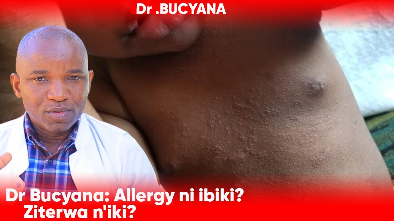 Dr BUCYANA : ALLERGY BURIYA NI IBIKI? ZABA ZITERWA N´IKI? ZIGIRA UMUTI?