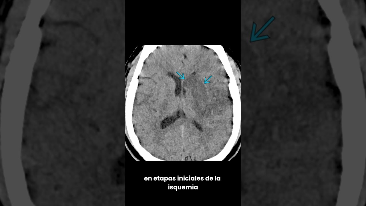&iquest;Conoces los signos tempranos del EVC en la TAC de cr&aacute;neo?
