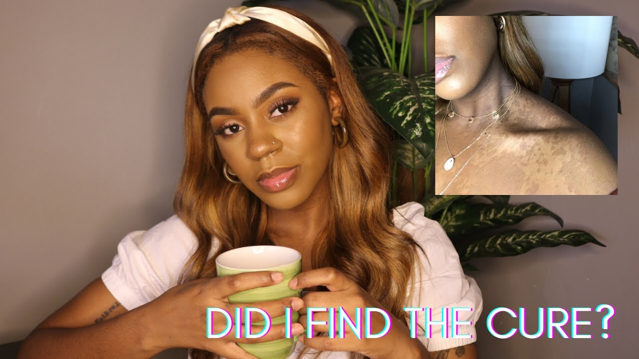 TINEA VERSICOLOR UPDATE | MY NEWEST REMEDY AND YOUR TIPS